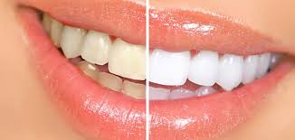 Try These Home Remedies For Sparkling Teeth And Fresh Breath