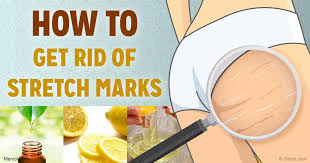 6 KITCHEN INGREDIENTS THAT GET RID OF STRETCH MARKS
