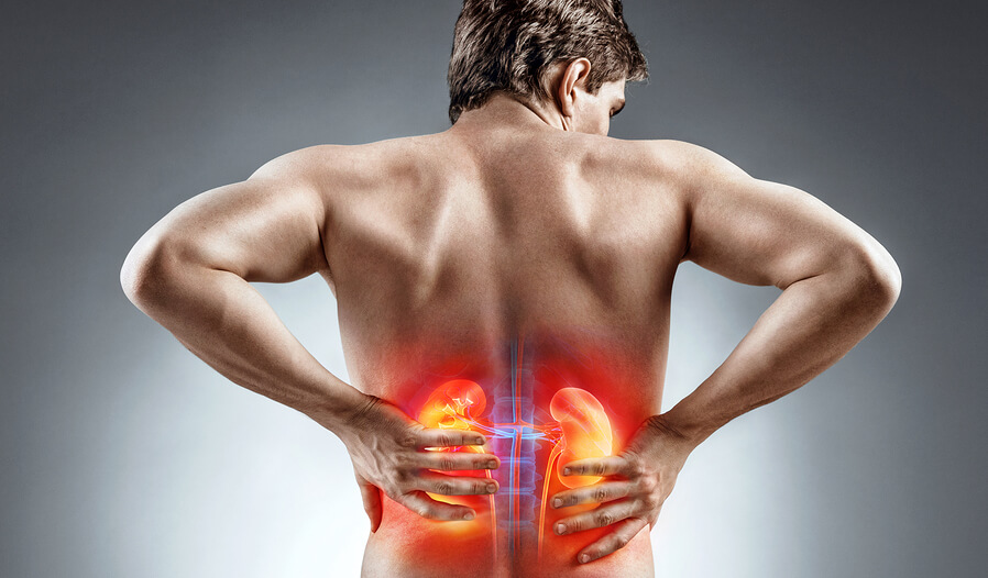 PREVENTING KIDNEY STONES THE NATURAL WAY