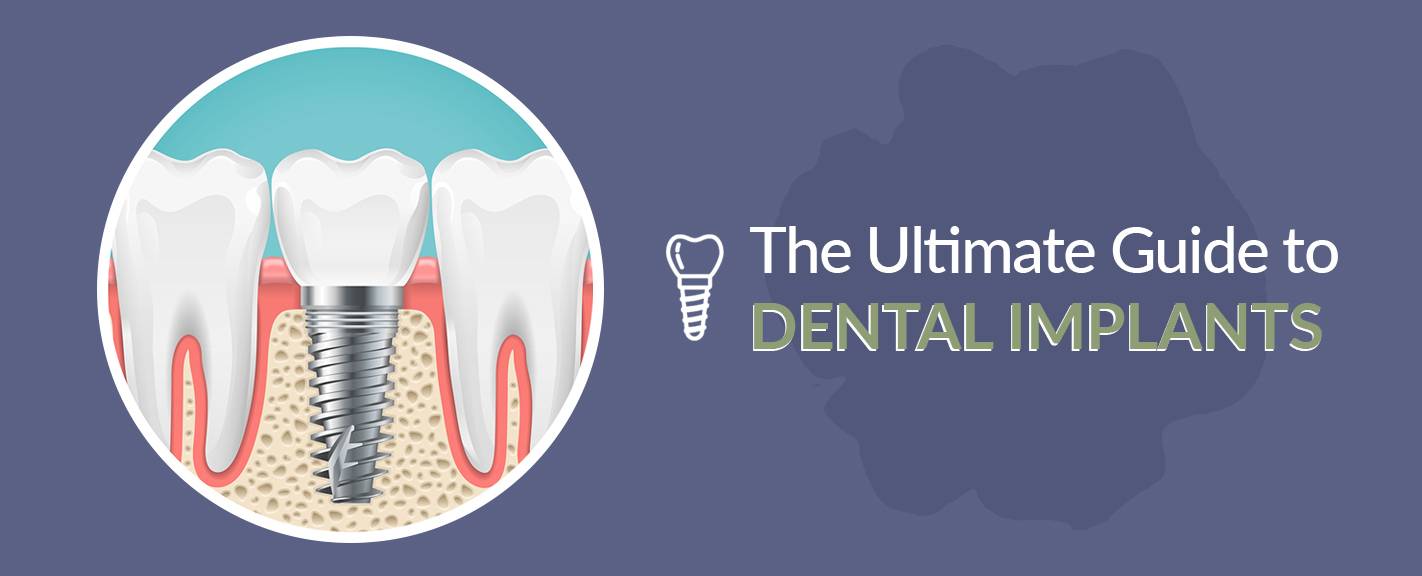 Dental Implants: Solving the Consequences of Poor Oral Hygiene